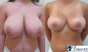Пластика груди: увеличение груди, уменьшение груди, поднятие груди, ассиметрия груди  